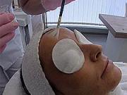 Chemický peeling - Dermatologia 