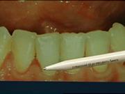 Ako vzniká zubný kaz, paradentóza a zápal ďasien - dentálna hygiena 2