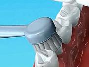 Elektrická zubná kefka - ako používať elektrickú zubnú kefku  - dentálna  hygiena 7